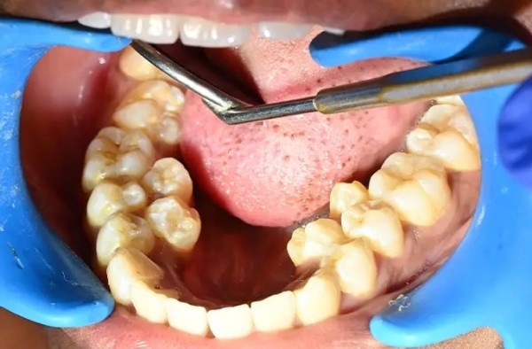 У девушки из Индии рекордное число зубов У девушки из Индии рекордное число зубов