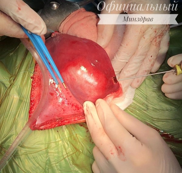 Спасли двухмесячного малыша. Белорусские хирурги впервые выполнили сложнейшую операцию Спасли двухмесячного малыша. Белорусские хирурги впервые выполнили сложнейшую операцию