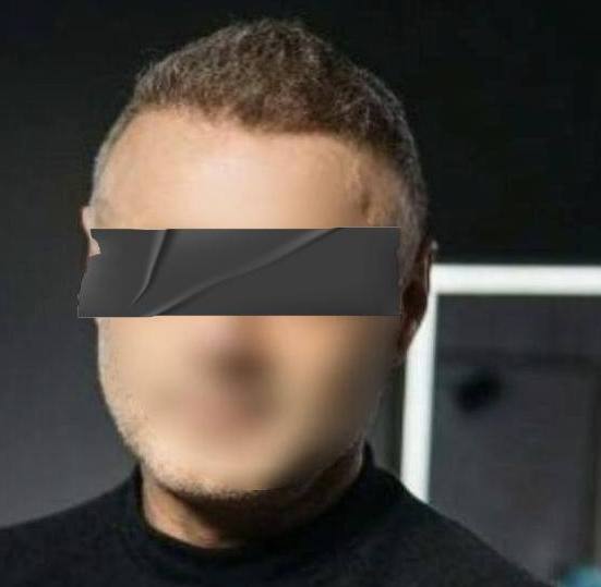 Белорус рассказал о трансплантации волос в Турции. Сколько стоит такая операция? Белорус рассказал о трансплантации волос в Турции. Сколько стоит такая операция?