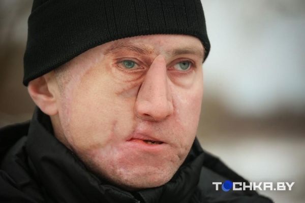 Белорус в жуткой аварии лишился глаза, получил страшные травмы и деформацию лица. Как он сейчас живет Белорус в жуткой аварии лишился глаза, получил страшные травмы и деформацию лица. Как он сейчас живет