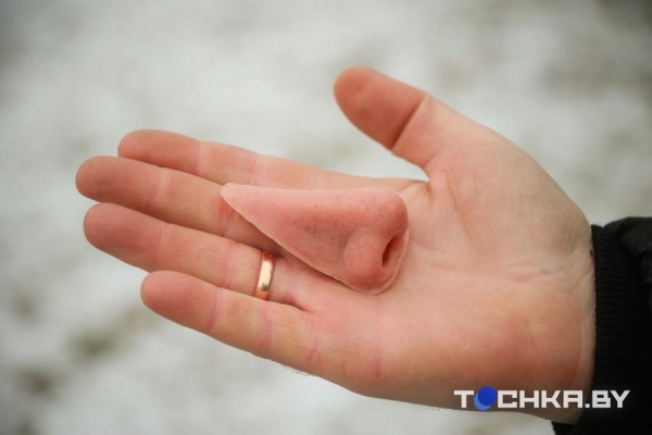 Белорус в жуткой аварии лишился глаза, получил страшные травмы и деформацию лица. Как он сейчас живет Белорус в жуткой аварии лишился глаза, получил страшные травмы и деформацию лица. Как он сейчас живет