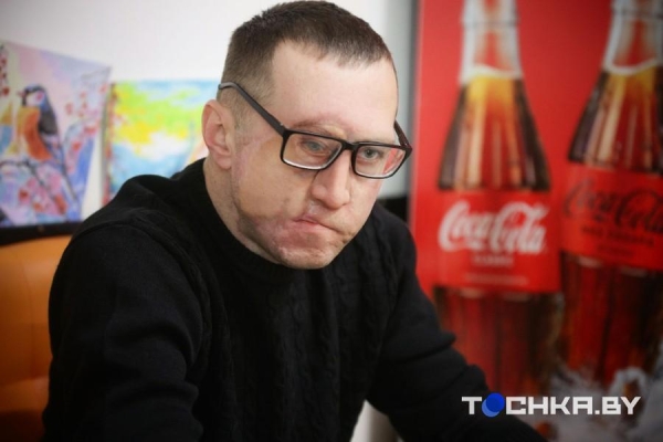 Белорус в жуткой аварии лишился глаза, получил страшные травмы и деформацию лица. Как он сейчас живет Белорус в жуткой аварии лишился глаза, получил страшные травмы и деформацию лица. Как он сейчас живет