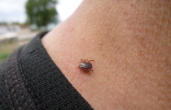 Укусил клещ. Что делать, рассказала врач Укусил клещ. Что делать, рассказала врач